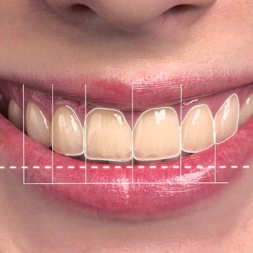 diseño digital de sonrisa como parte de la estetica dental..